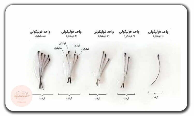 مراح کاشت مو به روش FUE