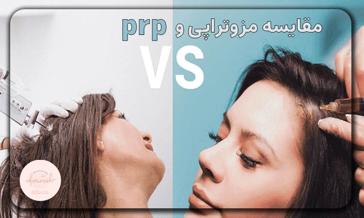 مقایسه مزو و prp