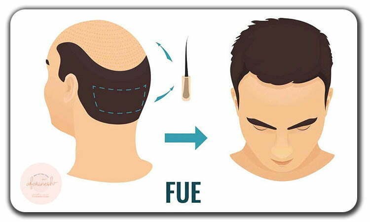 کاشت مو به روش fue