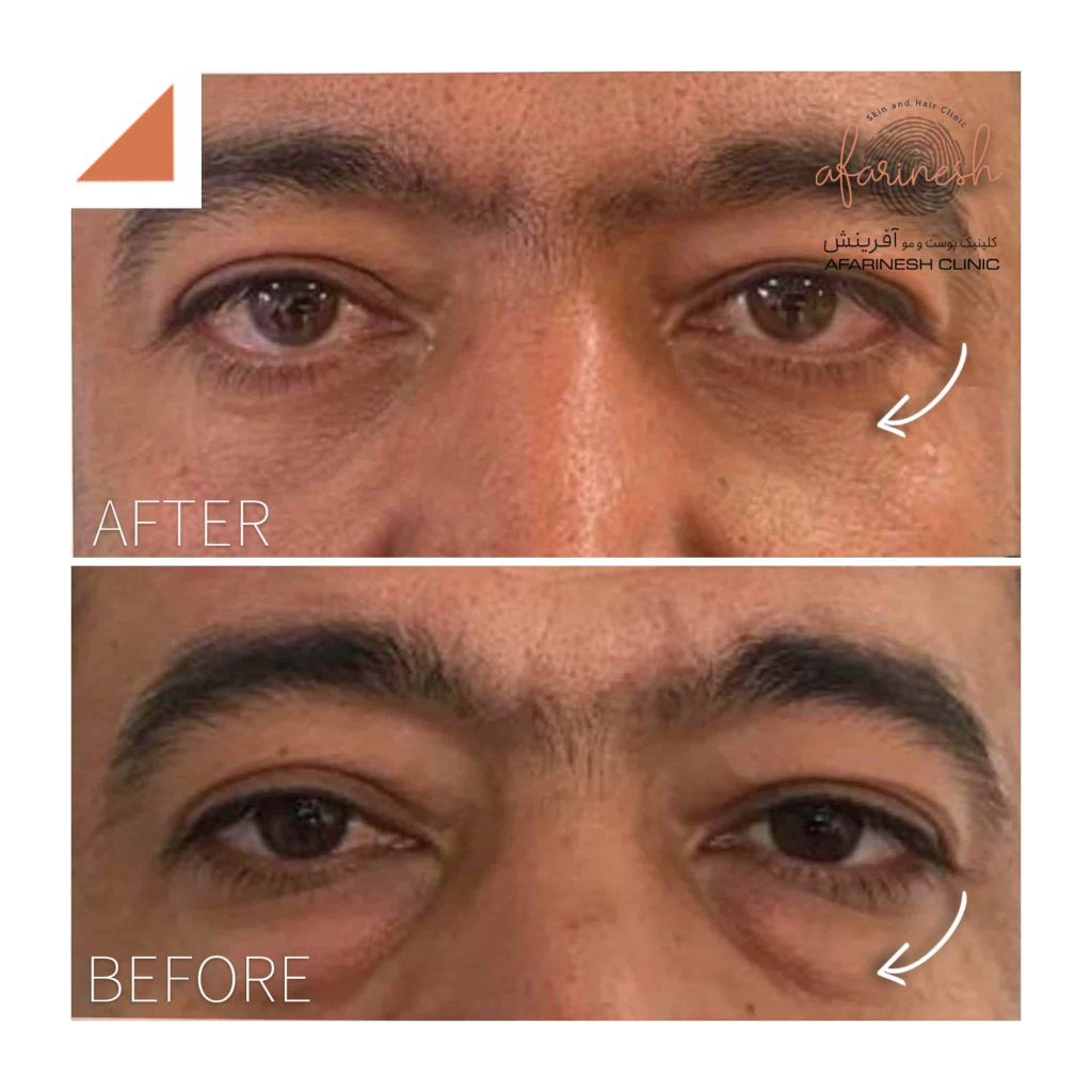 رفع پف زیر چشم در کلینیک آفرینش