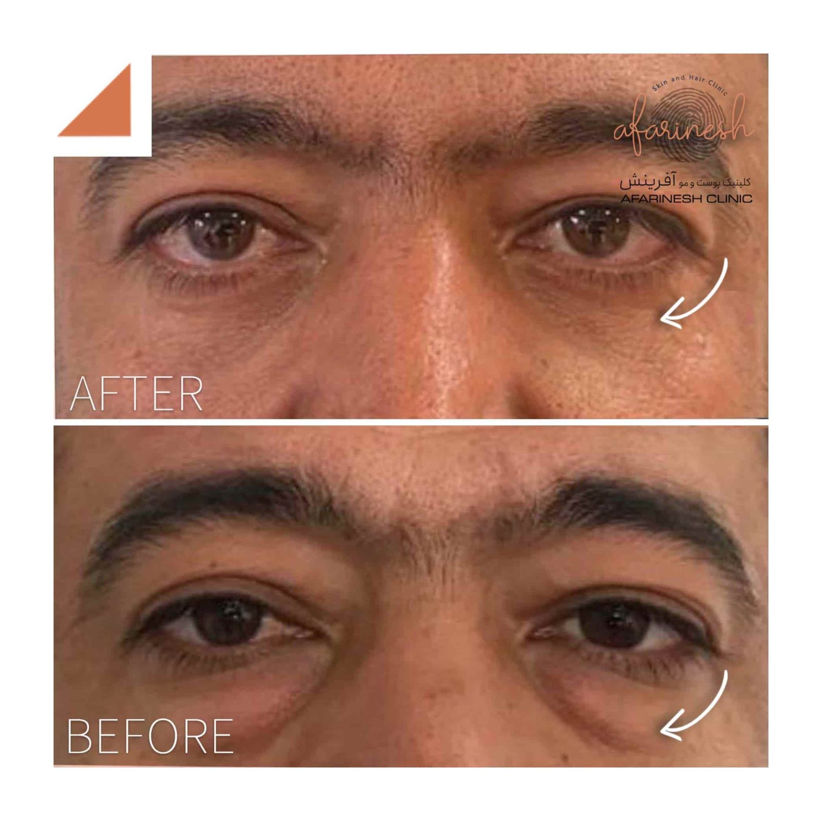 رفع پف زیر چشم در کلینیک آفرینش
