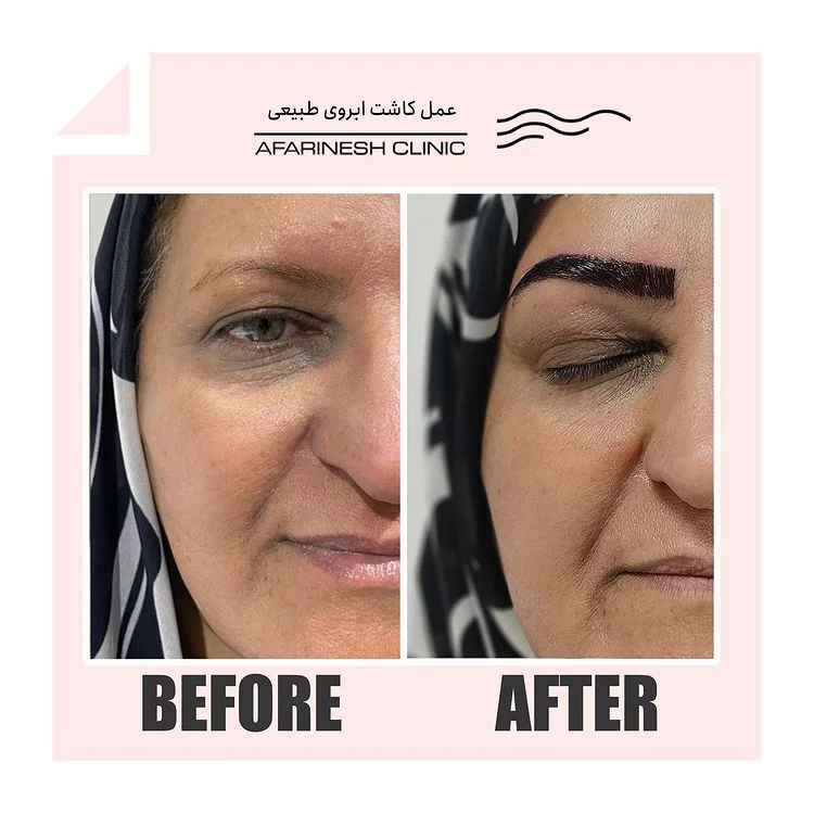 قبل و بعد کاشت ابرو در کلینیک آفرینش