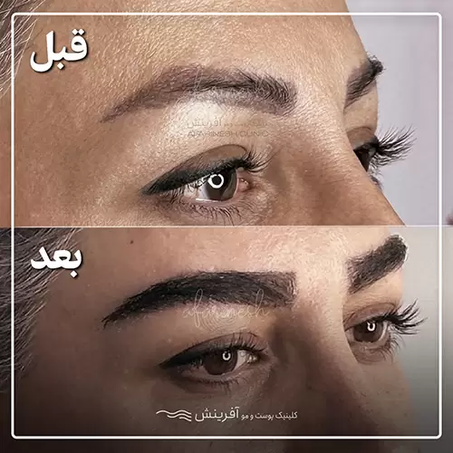 قبل و بعد از عمل کاشت ابرو