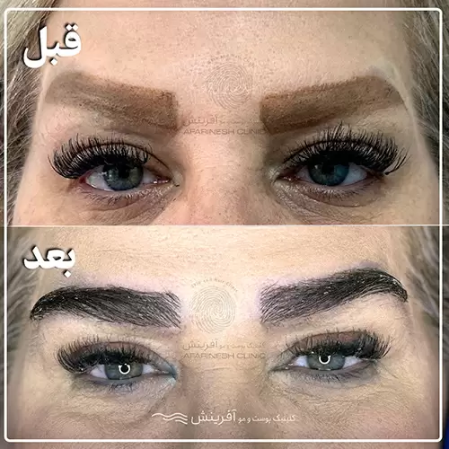 قبل و بعد از عمل کاشت ابرو طبیعی