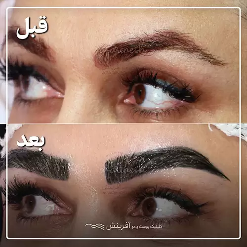 قبل و بعد از کاشت ابرو