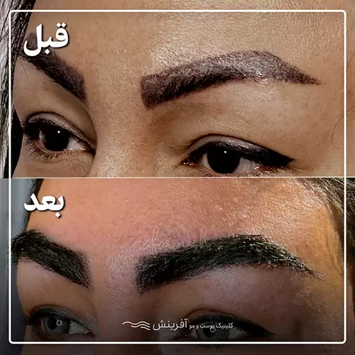 قبل و بعد از کاشت ابرو