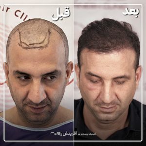 قبل و بعد از کاشت مو
