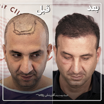 قبل و بعد از کاشت مو