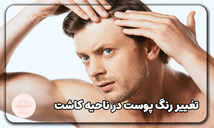 تغییر رنگ پوست در ناحیه کاشت