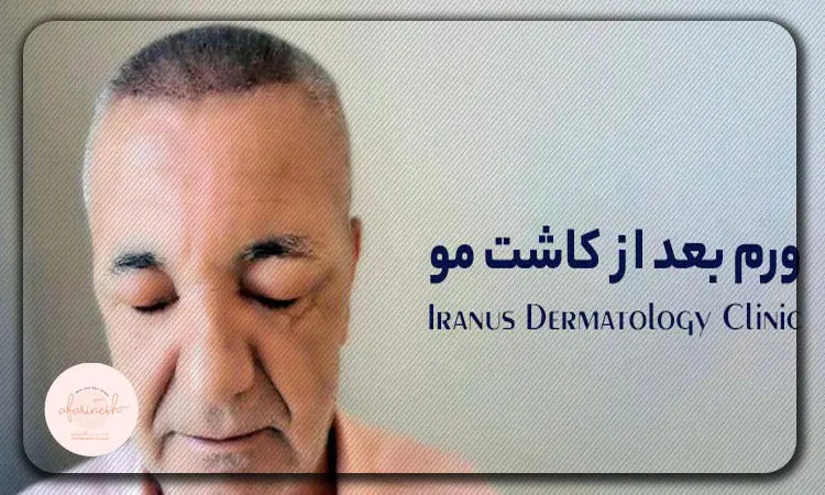 ورم صورت بعد از کاشت مو