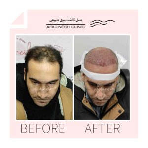 نمونه قبل و بعد کاشت مو