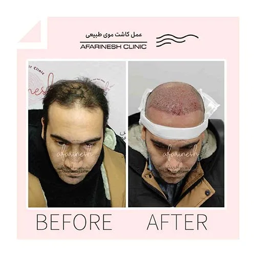 نمونه قبل و بعد کاشت مو