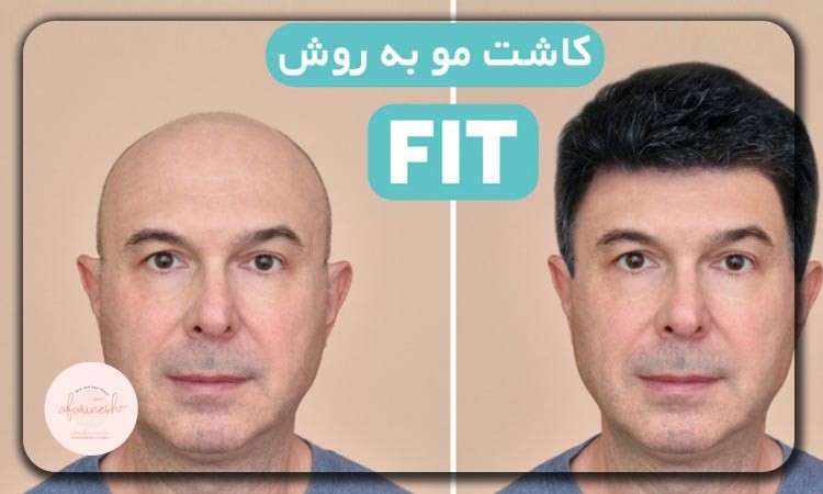 کاشت مو به روش FIT