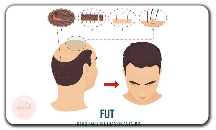 کاشت مو به روش FUT