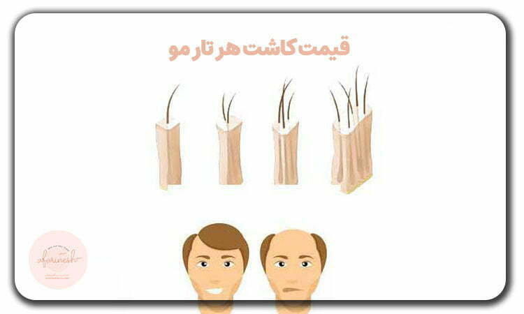 قیمت کاشت هر تار مو
