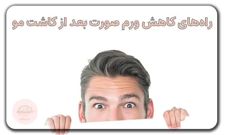 درمان ورم صورت بعد از کاشت مو