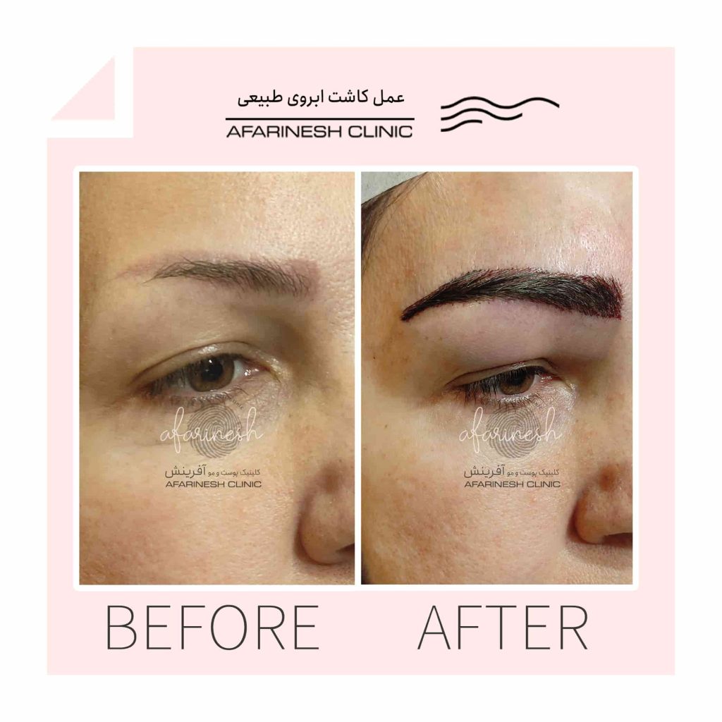 نمونه کاشت ابرو آفرینش