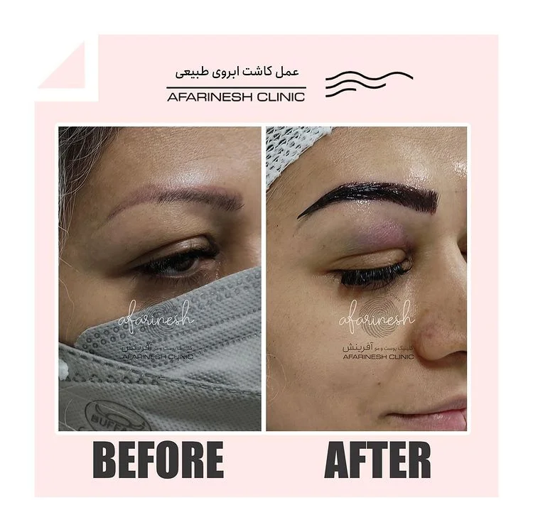 نمونه قبل و بعد از کاشت ابرو در کلینیک آفرینش