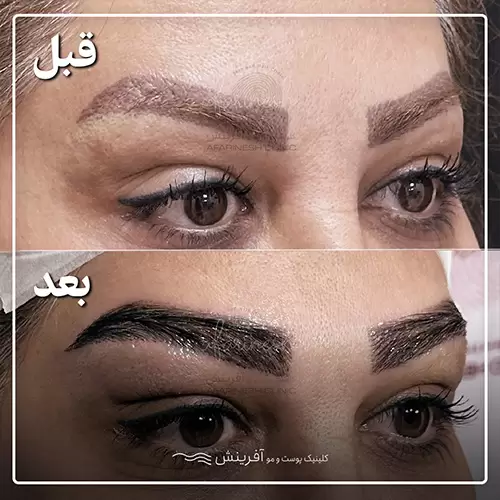 کاشت ابرو