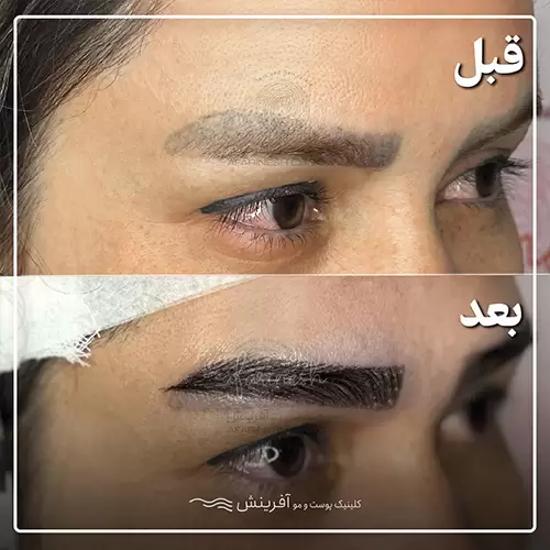قبل و بعد کاشت ابرو طبیعی