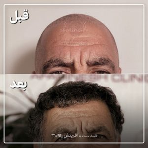 قبل و بعد کاشت مو در کلینیک آفرینش
