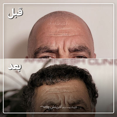 قبل و بعد کاشت مو در کلینیک آفرینش