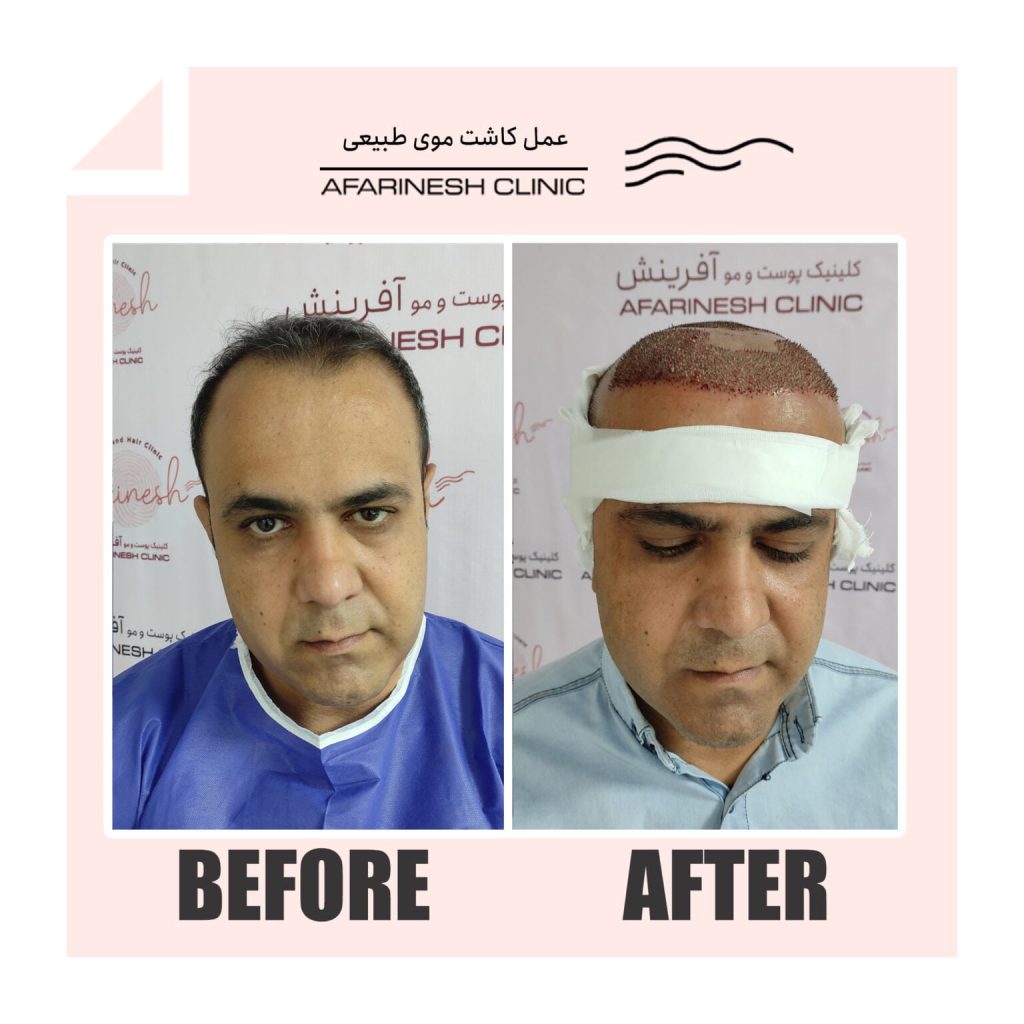قبل و بعد از کاشتن مو در کلینیک آفرینش