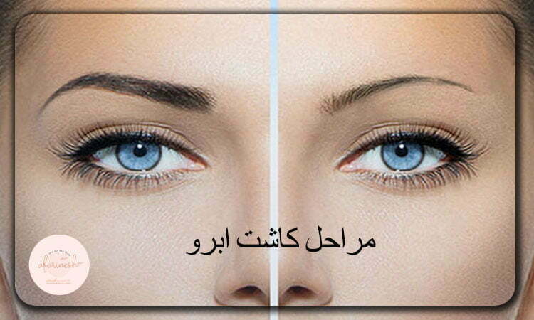 کاشت ابرو چه مراحلی دارد