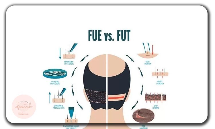 کاشت مو به روش fit بهتر است یا fut