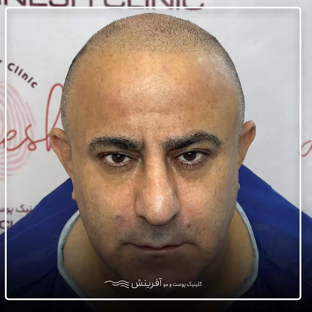 قبل از کاشت مو