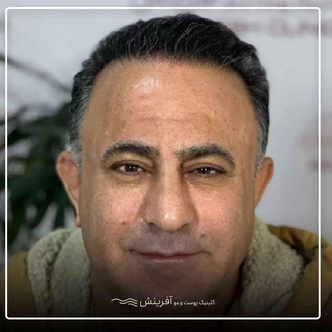 بعد از کاشت مو
