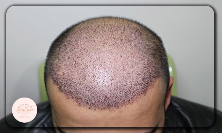 زمان کندن دلمه های کاشت مو