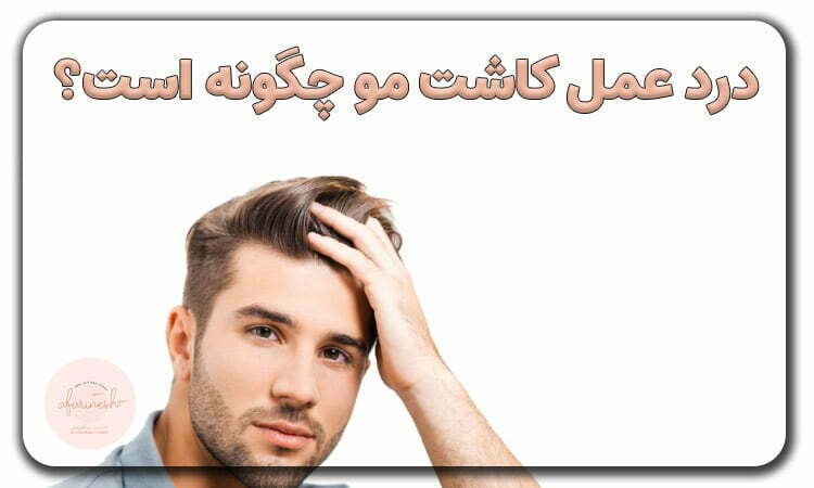درد عمل کاشت مو چقدر است؟