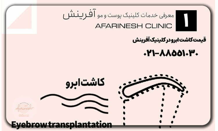 قیمت کاشت ابرو در کلینیک آفرینش در سال 1404