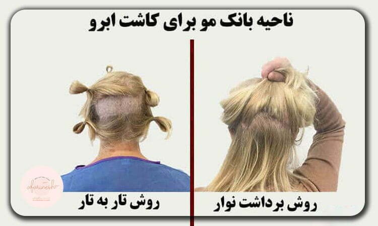 عکس برش پشت سر برای کاشت ابرو 