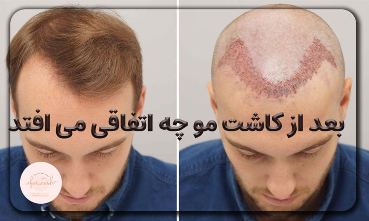 بعد از کاشت مو چه اتفاقی می افتد