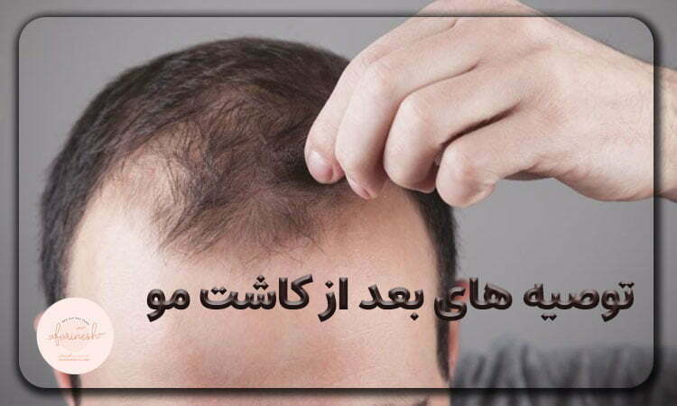 توصیه های بعد از کاشت مو