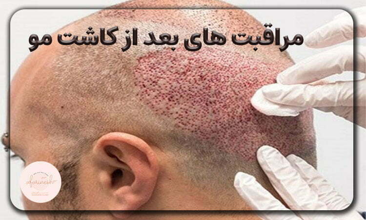 مراقبت بعد از کاشت مو