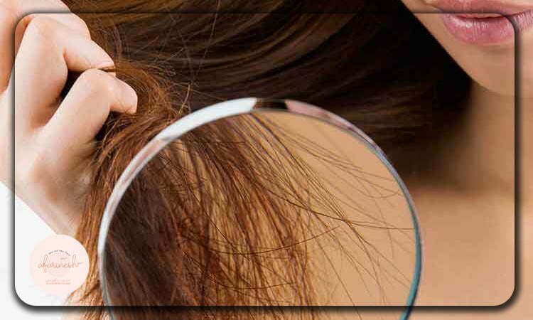 تاثیر مخرب نور آفتاب بر مو کاشته شده