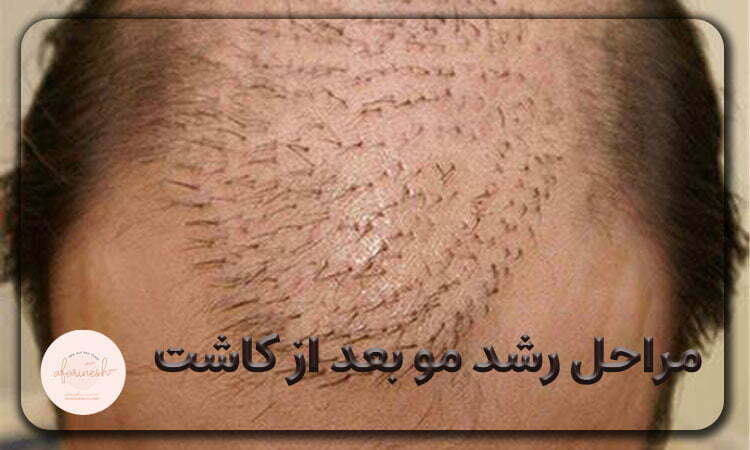 موها بعد از کاشت چقدر رشد می کنند