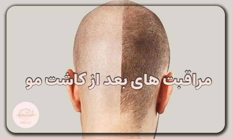 مراقبت های بعد از کاشت مو
