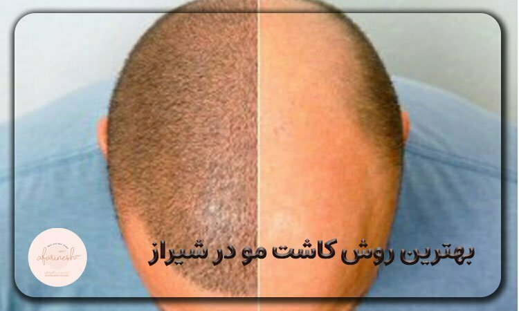 انواع روش کاشت مو در شیراز