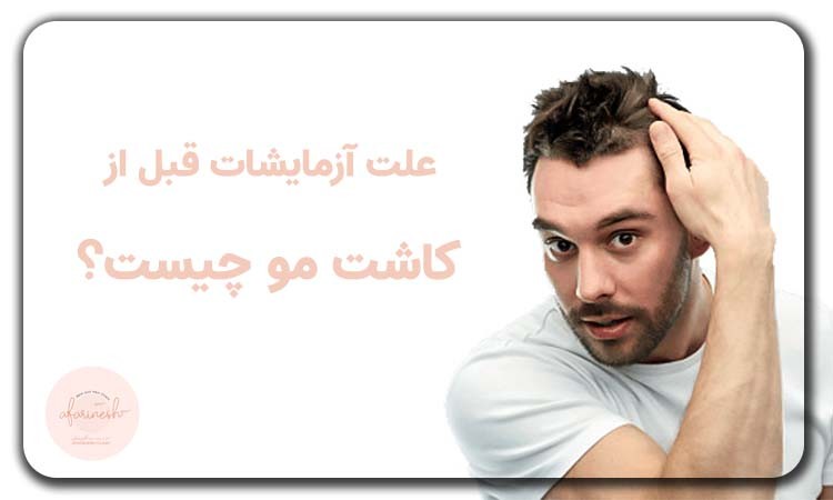 آزمایشات قبل از کاشت مو