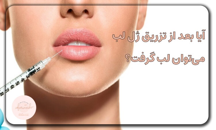 آیا بعد از تزریق ژل لب می‌توان لب گرفت؟