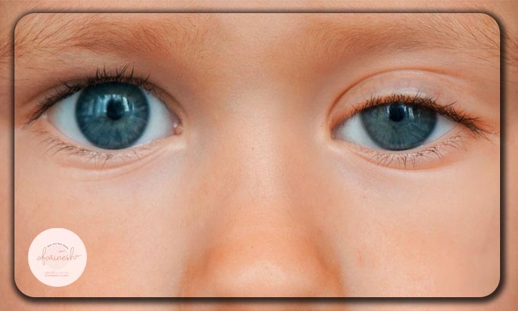 عکس افتادگی پلک نوزادان