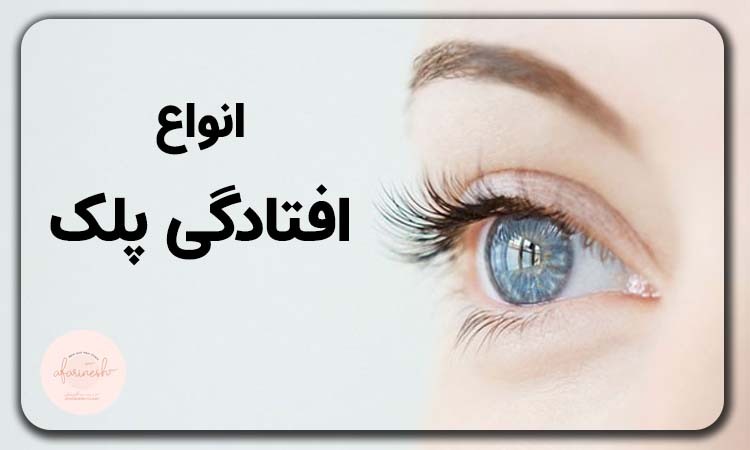 انواع افتادگی پلک