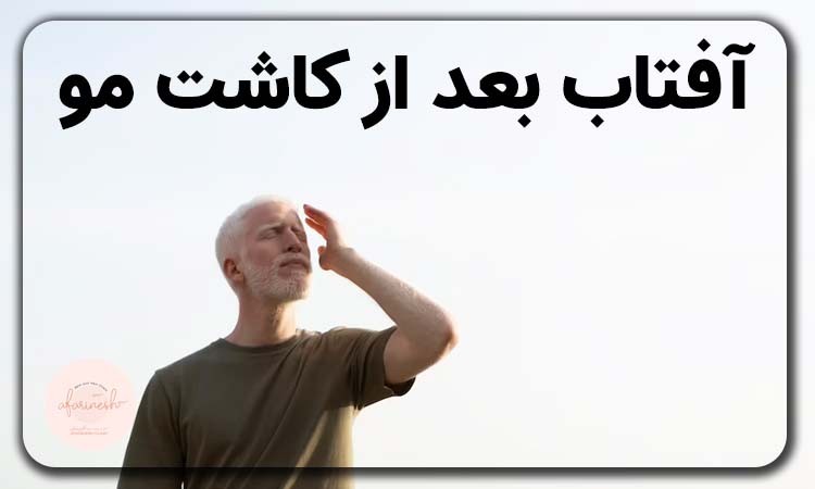 تاثیر آفتاب بعد از کاشت مو