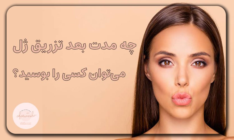 چه مدت بعد تزریق ژل لب می‌توان کسی را بوسید؟