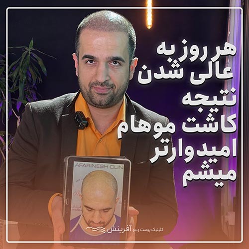 نظر کسی که کاشت مو انجام داده