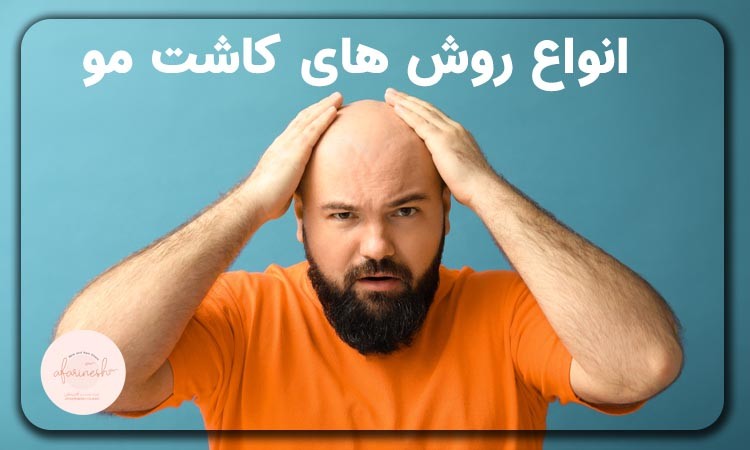 بهترین روش کاشت مو